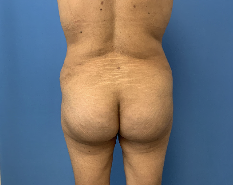Brazilian-Butt-Lift--Case-Study-3682 | After Body